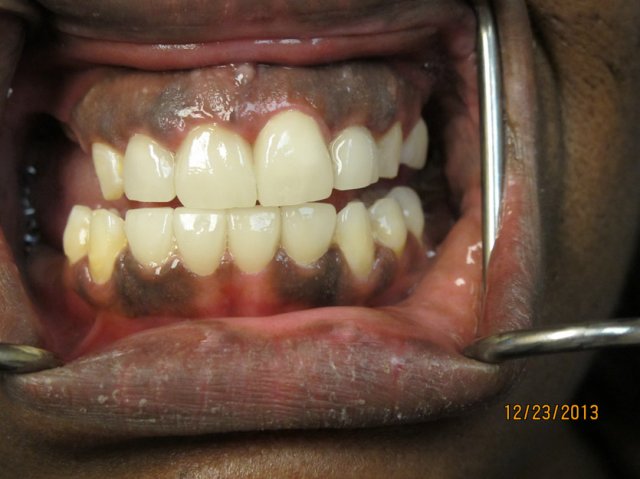 Smile Line Crowns After