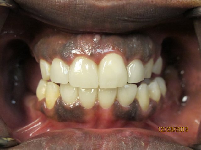 Smile Line Crowns After