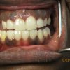 Smile Line Crowns After