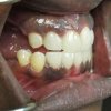 Smile Line Crowns After