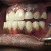 Smile Line Crowns After