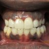 Smile Line Crowns After