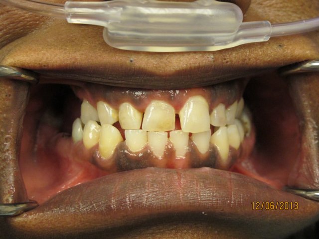 Smile Line Crowns Before