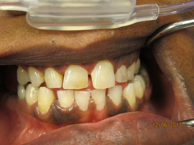 Smile Line Crowns Before