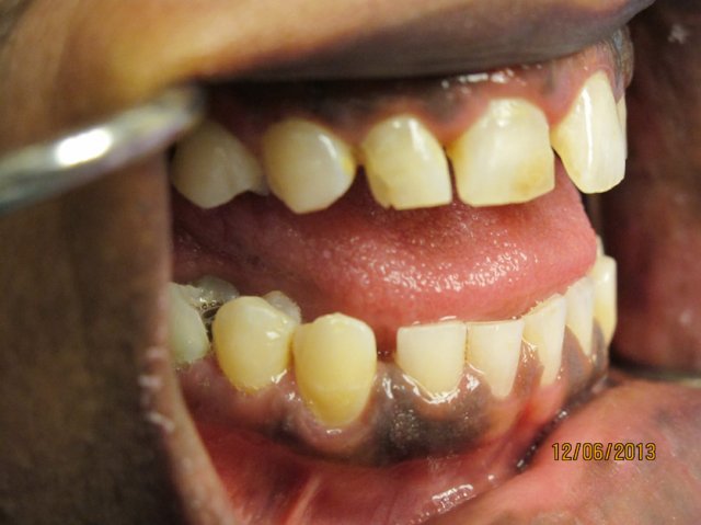 Smile Line Crowns Before