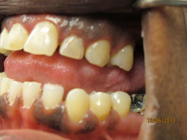 Smile Line Crowns Before
