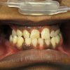 Smile Line Crowns Before