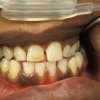 Smile Line Crowns Before