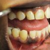 Smile Line Crowns Before
