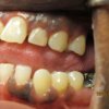 Smile Line Crowns Before