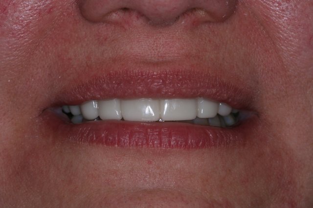 Snap On Smile After