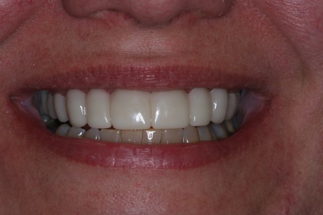 Snap On Smile After