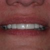 Snap On Smile After