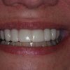 Snap On Smile After
