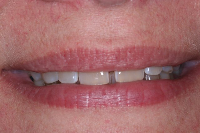 Snap On Smile Before