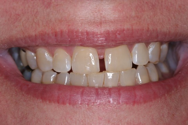Snap On Smile Before