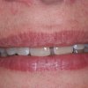 Snap On Smile Before